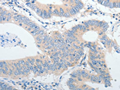 The image on the left is immunohistochemistry of paraffin-embedded Human colon cancer tissue using IGFBP1 Antibody(IGFBP1 Antibody) at dilution 1/30, on the right is treated with synthetic peptide. (Original magnification: ×200)