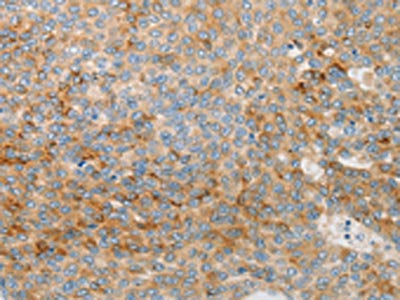The image on the left is immunohistochemistry of paraffin-embedded Human liver cancer tissue using the antibody Antibody) at dilution 1/30, on the right is treated with synthetic peptide. (Original magnification: ×200)