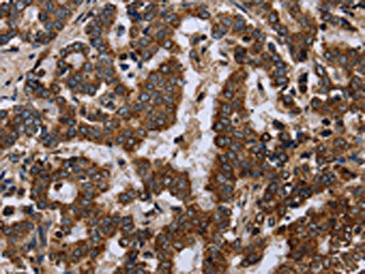 The image on the left is immunohistochemistry of paraffin-embedded Human liver cancer tissue using the antibody Antibody) at dilution 1/20, on the right is treated with fusion protein. (Original magnification: ×200)Rabbit anti-Human FIS1 Polyclonal Antibody