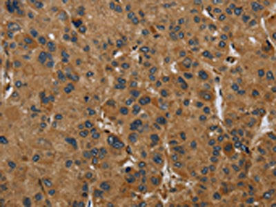 The image on the left is immunohistochemistry of paraffin-embedded Human liver cancer tissue using the antibody Antibody) at dilution 1/60, on the right is treated with fusion protein. (Original magnification: ×200)Rabbit anti-Human PAEP Polyclonal Antibody