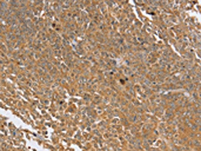 The image on the left is immunohistochemistry of paraffin-embedded Human cervical cancer tissue using the antibody Antibody) at dilution 1/30, on the right is treated with synthetic peptide. (Original magnification: ×200)Rabbit anti-Human PTPN20A; Polyclonal Antibody