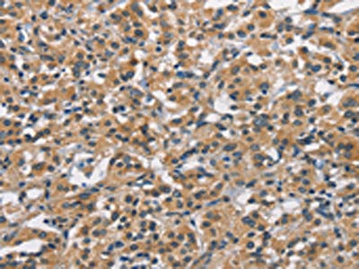 The image on the left is immunohistochemistry of paraffin-embedded Human thyroid cancer tissue using APOL1 Antibody(APOL1 Antibody) at dilution 1/40, on the right is treated with synthetic peptide. (Original magnification: ×200)Rabbit anti-Human APOL1 Polyclonal Antibody