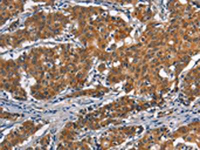 The image on the left is immunohistochemistry of paraffin-embedded Human gastic cancer tissue using the antibody Antibody) at dilution 1/40, on the right is treated with synthetic peptide. (Original magnification: ×200)Rabbit anti-Human APOL1 Polyclonal Antibody