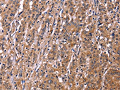 The image on the left is immunohistochemistry of paraffin-embedded Human gastric cancer tissue using SEPT7 Antibody(SEPT7 Antibody) at dilution 1/50, on the right is treated with fusion protein. (Original magnification: ×200)Rabbit anti-Human SEPT7 Polyclonal Antibody