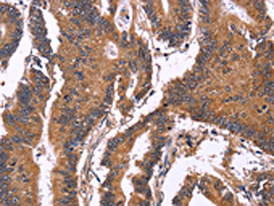 The image on the left is immunohistochemistry of paraffin-embedded Human colon cancer tissue using the antibody Antibody) at dilution 1/50, on the right is treated with fusion protein. (Original magnification: ×200)Rabbit anti-Human SEPT7 Polyclonal Antibody