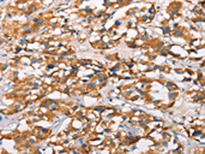 The image on the left is immunohistochemistry of paraffin-embedded Human thyroid cancer tissue using MARC1 Antibody(MARC1 Antibody) at dilution 1/40, on the right is treated with synthetic peptide. (Original magnification: ×200)