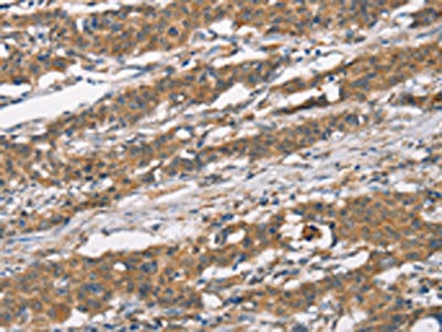 The image on the left is immunohistochemistry of paraffin-embedded Human gastic cancer tissue using the antibody Antibody) at dilution 1/40, on the right is treated with synthetic peptide. (Original magnification: ×200)
