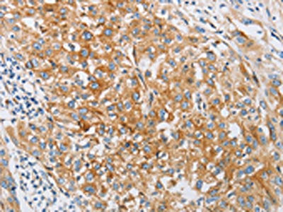 The image on the left is immunohistochemistry of paraffin-embedded Human esophagus cancer tissue using IFITM3 Antibody(IFITM3 Antibody) at dilution 1/25, on the right is treated with fusion protein. (Original magnification: ×200)Rabbit anti-Human IFITM3 Polyclonal Antibody