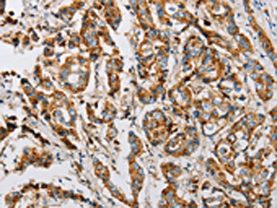 The image on the left is immunohistochemistry of paraffin-embedded Human breast cancer tissue using the antibody Antibody) at dilution 1/25, on the right is treated with fusion protein. (Original magnification: ×200)Rabbit anti-Human IFITM3 Polyclonal Antibody