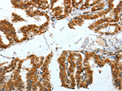 The image on the left is immunohistochemistry of paraffin-embedded Human thyroid cancer tissue using BNIP1 Antibody(BNIP1 Antibody) at dilution 1/30, on the right is treated with fusion protein. (Original magnification: ×200)