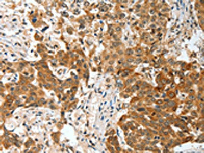 The image on the left is immunohistochemistry of paraffin-embedded Human esophagus cancer tissue using the antibody Antibody) at dilution 1/30, on the right is treated with fusion protein. (Original magnification: ×200)