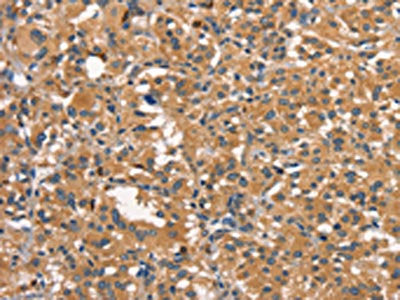 The image on the left is immunohistochemistry of paraffin-embedded Human thyroid cancer tissue using DNM2 Antibody(DNM2 Antibody) at dilution 1/40, on the right is treated with synthetic peptide. (Original magnification: ×200)Rabbit anti-Human DNM2 Polyclonal Antibody