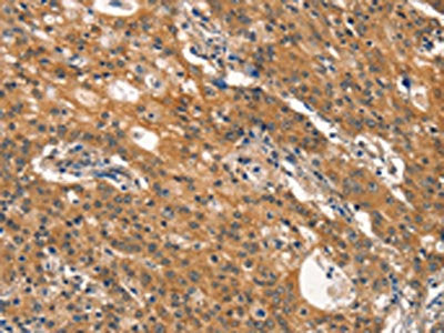 The image on the left is immunohistochemistry of paraffin-embedded Human gastic cancer tissue using the antibody Antibody) at dilution 1/40, on the right is treated with synthetic peptide. (Original magnification: ×200)Rabbit anti-Human DNM2 Polyclonal Antibody