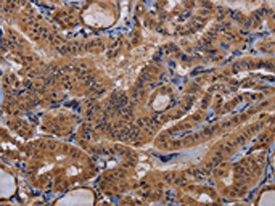 The image on the left is immunohistochemistry of paraffin-embedded Human thyroid cancer tissue using the antibody Antibody) at dilution 1/60, on the right is treated with fusion protein. (Original magnification: ×200)