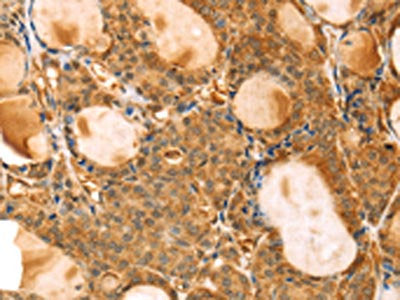 The image on the left is immunohistochemistry of paraffin-embedded Human thyroid cancer tissue using VIM Antibody(VIM Antibody) at dilution 1/20, on the right is treated with fusion protein. (Original magnification: ×200)Rabbit anti-Human VIM Polyclonal Antibody