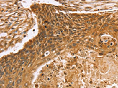 The image on the left is immunohistochemistry of paraffin-embedded Human esophagus cancer tissue using the antibody Antibody) at dilution 1/20, on the right is treated with fusion protein. (Original magnification: ×200)Rabbit anti-Human VIM Polyclonal Antibody