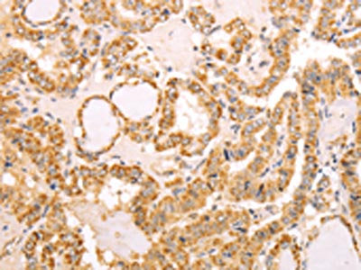 The image on the left is immunohistochemistry of paraffin-embedded Human thyroid cancer tissue using NAMPT Antibody(NAMPT Antibody) at dilution 1/30, on the right is treated with fusion protein. (Original magnification: ×200)Rabbit anti-Human NAMPT Polyclonal Antibody
