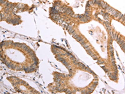 The image on the left is immunohistochemistry of paraffin-embedded Human colon cancer tissue using the antibody Antibody) at dilution 1/30, on the right is treated with fusion protein. (Original magnification: ×200)Rabbit anti-Human NAMPT Polyclonal Antibody