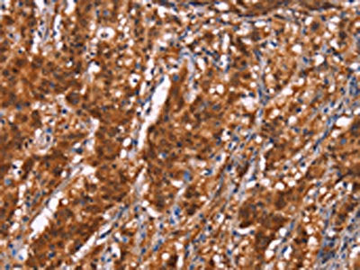 The image on the left is immunohistochemistry of paraffin-embedded Human gastric cancer tissue using BRK1 Antibody(BRK1 Antibody) at dilution 1/40, on the right is treated with synthetic peptide. (Original magnification: ×200)