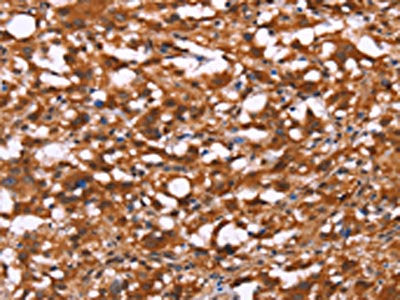 The image on the left is immunohistochemistry of paraffin-embedded Human thyroid cancer tissue using the antibody Antibody) at dilution 1/40, on the right is treated with synthetic peptide. (Original magnification: ×200)