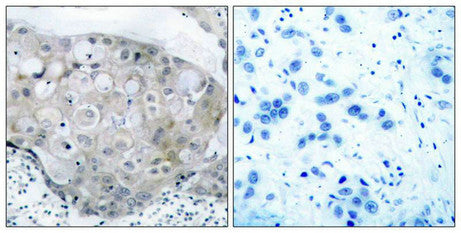 Immunohistochemical analysis of paraffin-embedded human breast carcinoma tissue using VEGFR2(Phospho-Tyr951) Antibody(left) or the same antibody preincubated with blocking peptide(right).
