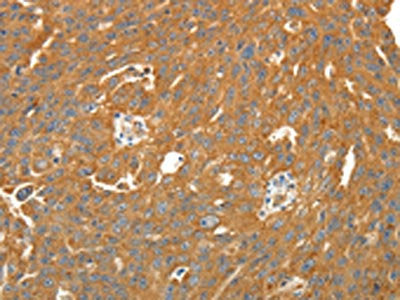 The image on the left is immunohistochemistry of paraffin-embedded Human ovarian cancer tissue using SIRT4 Antibody(SIRT4 Antibody) at dilution 1/25. (Original magnification: ×200)Rabbit anti-Human SIRT4 Polyclonal Antibody