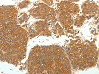 The image on the left is immunohistochemistry of paraffin-embedded Human liver cancer tissue using the antibody Antibody) at dilution 1/25. (Original magnification: ×200)Rabbit anti-Human SIRT4 Polyclonal Antibody