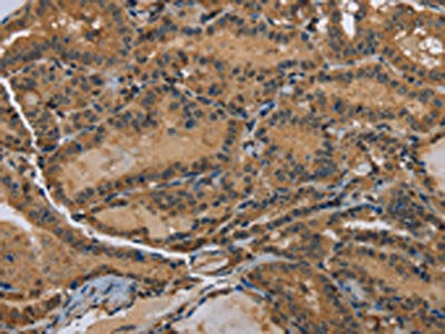The image on the left is immunohistochemistry of paraffin-embedded Human thyroid cancer tissue using DNAJA1 Antibody(DNAJA1 Antibody) at dilution 1/60, on the right is treated with fusion protein. (Original magnification: ×200)Rabbit anti-Human DNAJA1 Polyclonal Antibody