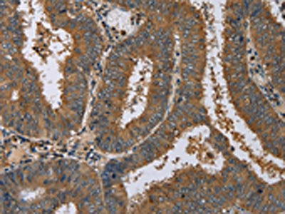 The image on the left is immunohistochemistry of paraffin-embedded Human colon cancer tissue using the antibody Antibody) at dilution 1/60, on the right is treated with fusion protein. (Original magnification: ×200)Rabbit anti-Human DNAJA1 Polyclonal Antibody