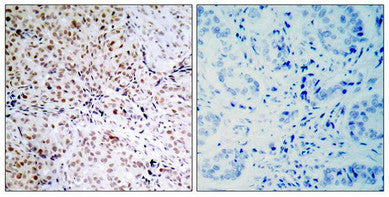 Immunohistochemical analysis of paraffin-embedded human breast carcinoma tissue using Rb(Phospho-Ser795) Antibody(left) or the same antibody preincubated with blocking peptide(right).Rabbit anti-Human RB1 Polyclonal Antibody