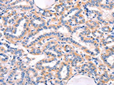 The image on the left is immunohistochemistry of paraffin-embedded Human thyroid cancer tissue using AMY2A Antibody(AMY2A Antibody) at dilution 1/50, on the right is treated with fusion protein. (Original magnification: ×200)Rabbit anti-Human AMY2A Polyclonal Antibody