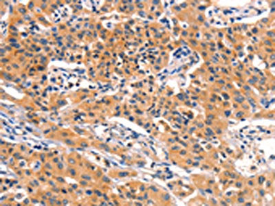 The image on the left is immunohistochemistry of paraffin-embedded Human lung cancer tissue using the antibody Antibody) at dilution 1/50, on the right is treated with fusion protein. (Original magnification: ×200)Rabbit anti-Human AMY2A Polyclonal Antibody