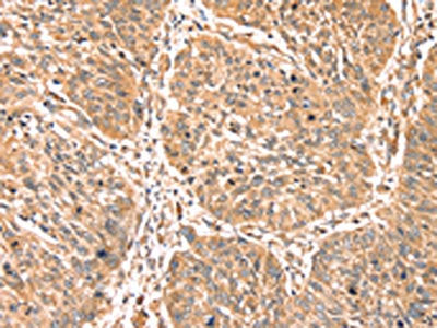 The image on the left is immunohistochemistry of paraffin-embedded Human lung cancer tissue using PDLIM4 Antibody(PDLIM4 Antibody) at dilution 1/40, on the right is treated with fusion protein. (Original magnification: ×200)Rabbit anti-Human PDLIM4 Polyclonal Antibody