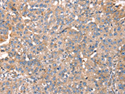 The image on the left is immunohistochemistry of paraffin-embedded Human breast cancer tissue using the antibody Antibody) at dilution 1/40, on the right is treated with fusion protein. (Original magnification: ×200)Rabbit anti-Human PDLIM4 Polyclonal Antibody