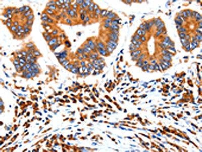 The image on the left is immunohistochemistry of paraffin-embedded Human colon cancer tissue using HCN1 Antibody(HCN1 Antibody) at dilution 1/80, on the right is treated with synthetic peptide. (Original magnification: ×200)Rabbit anti-Human HCN1 Polyclonal Antibody
