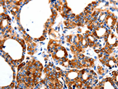 The image on the left is immunohistochemistry of paraffin-embedded Human thyroid cancer tissue using the antibody Antibody) at dilution 1/80, on the right is treated with synthetic peptide. (Original magnification: ×200)Rabbit anti-Human HCN1 Polyclonal Antibody