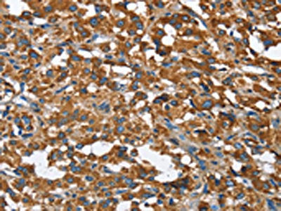 The image on the left is immunohistochemistry of paraffin-embedded Human thyroid cancer tissue using BGN Antibody(BGN Antibody) at dilution 1/50, on the right is treated with fusion protein. (Original magnification: ×200)