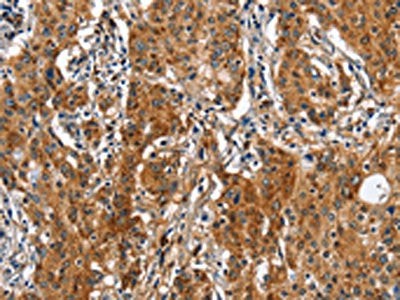 The image on the left is immunohistochemistry of paraffin-embedded Human gastic cancer tissue using the antibody Antibody) at dilution 1/50, on the right is treated with fusion protein. (Original magnification: ×200)