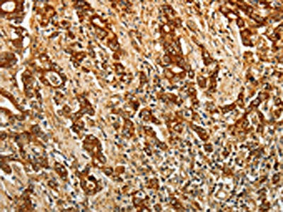 The image on the left is immunohistochemistry of paraffin-embedded Human gastric cancer tissue using AKR1B1 Antibody(AKR1B1 Antibody) at dilution 1/40, on the right is treated with synthetic peptide. (Original magnification: ×200)Rabbit anti-Human AKR1B1 Polyclonal Antibody