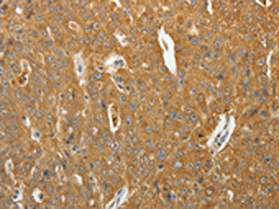 The image on the left is immunohistochemistry of paraffin-embedded Human ovarian cancer tissue using the antibody Antibody) at dilution 1/40, on the right is treated with synthetic peptide. (Original magnification: ×200)Rabbit anti-Human AKR1B1 Polyclonal Antibody