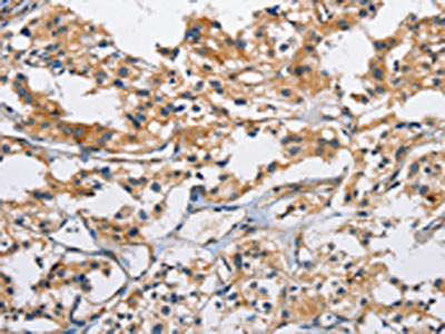 The image on the left is immunohistochemistry of paraffin-embedded Human thyroid cancer tissue using CD207 Antibody(CD207 Antibody) at dilution 1/40, on the right is treated with fusion protein. (Original magnification: x200)Rabbit anti-Human CD207 Polyclonal Antibody