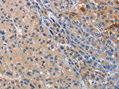 The image on the left is immunohistochemistry of paraffin-embedded Human liver cancer tissue using the antibody Antibody) at dilution 1/40, on the right is treated with fusion protein. (Original magnification: x200)Rabbit anti-Human CD207 Polyclonal Antibody
