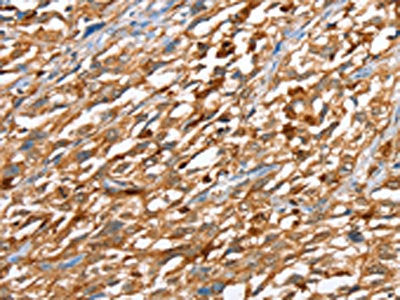 The image on the left is immunohistochemistry of paraffin-embedded Human esophagus cancer tissue using CAPG Antibody(CAPG Antibody) at dilution 1/40, on the right is treated with fusion protein. (Original magnification: ×200)