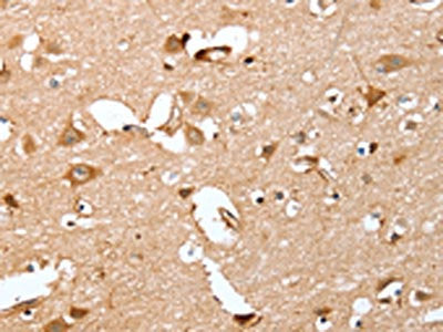 The image on the left is immunohistochemistry of paraffin-embedded Human brain tissue using the antibody Antibody) at dilution 1/40, on the right is treated with fusion protein. (Original magnification: ×200)