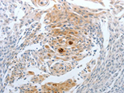 The image on the left is immunohistochemistry of paraffin-embedded Human cervical cancer tissue using CST3 Antibody(CST3 Antibody) at dilution 1/20, on the right is treated with synthetic peptide. (Original magnification: ×200)Rabbit anti-Human CST3 Polyclonal Antibody
