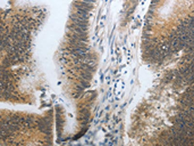 The image on the left is immunohistochemistry of paraffin-embedded Human colon cancer tissue using the antibody Antibody) at dilution 1/20, on the right is treated with synthetic peptide. (Original magnification: ×200)Rabbit anti-Human CST3 Polyclonal Antibody