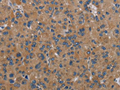 The image on the left is immunohistochemistry of paraffin-embedded Human liver cancer tissue using NDUFA9 Antibody(NDUFA9 Antibody) at dilution 1/30, on the right is treated with fusion protein. (Original magnification: ×200)Rabbit anti-Human NDUFA9 Polyclonal Antibody
