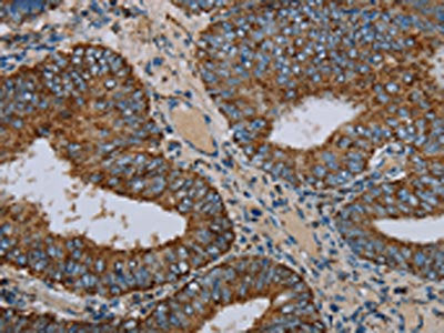 The image on the left is immunohistochemistry of paraffin-embedded Human colon cancer tissue using the antibody Antibody) at dilution 1/30, on the right is treated with fusion protein. (Original magnification: ×200)Rabbit anti-Human NDUFA9 Polyclonal Antibody