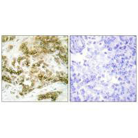 Immunohistochemistry analysis of paraffin-embedded human breast carcinoma tissue using TBX15/18 antibody.Rabbit anti-Human TBX15/TBX18 Polyclonal Antibody
