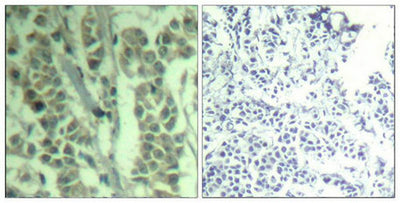 Immunohistochemical analysis of paraffin-embedded human breast carcinoma tissue using c-Cbl(Phospho-Tyr700) Antibody(left) or the same antibody preincubated with blocking peptide(right).